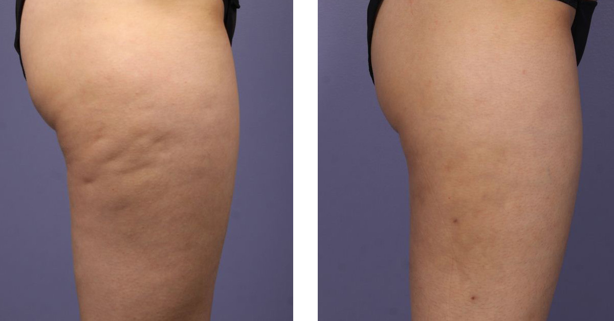 cellulite