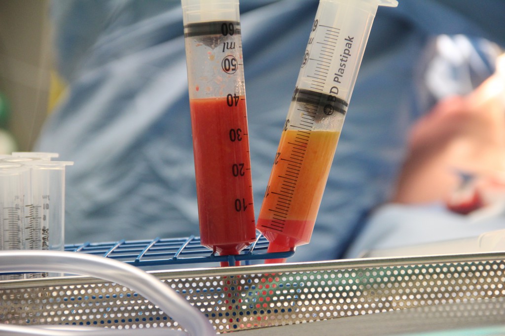 lipofilling-2 Lipofilling