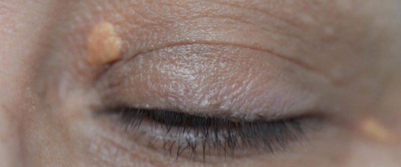 Xantelasma